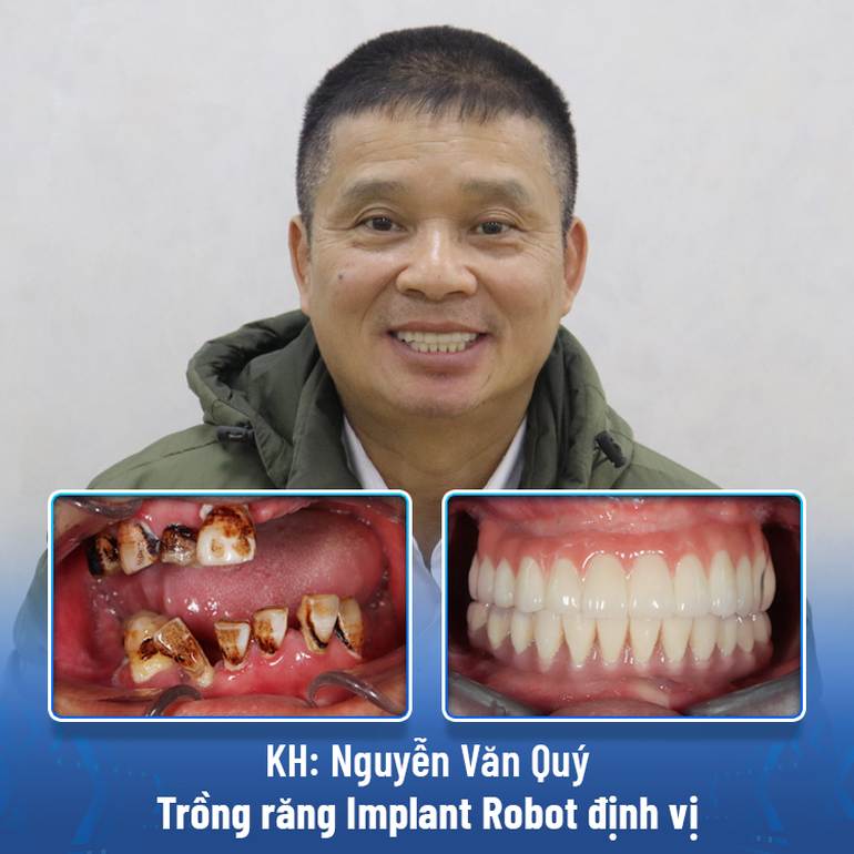 Trồng răng implant 4.0 bằng Robot định vị: An toàn - Không đau - Chính xác tuyệt đối - 4 Trồng răng implant 4.0 bằng Robot định vị: An toàn - Không đau - Chính xác tuyệt đối - 4