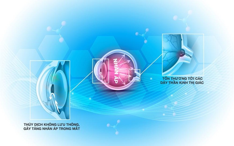 Chủ động tầm soát để tránh nguy cơ mất thị lực do Glôcôm