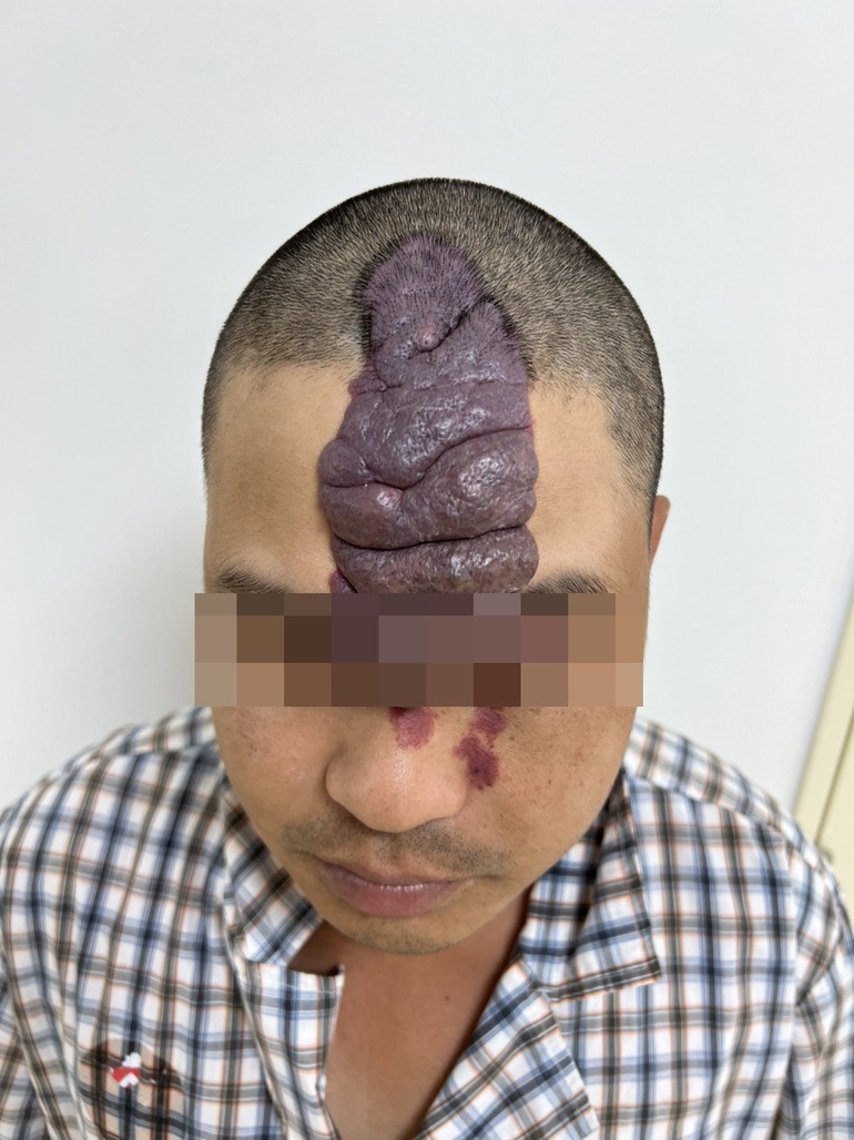 Giải cứu gương mặt có chú sâu khổng lồ bám chặt suốt 36 năm - 1 Giải cứu gương mặt có chú sâu khổng lồ bám chặt suốt 36 năm - 1