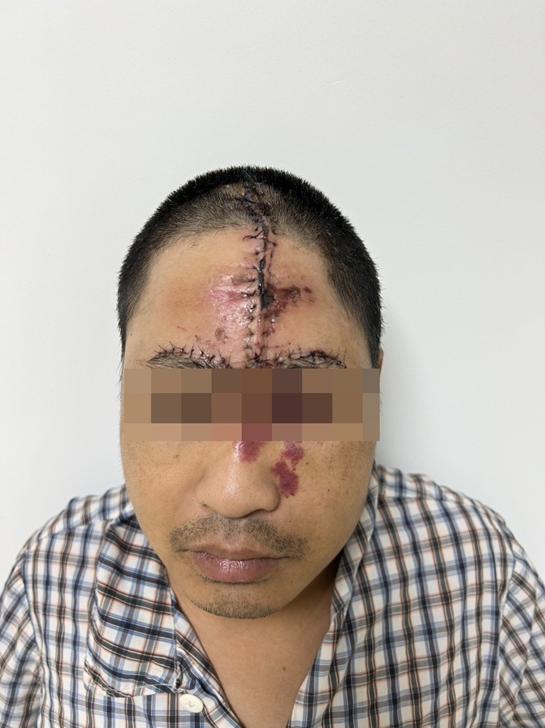 Giải cứu gương mặt có chú sâu khổng lồ bám chặt suốt 36 năm - 2 Giải cứu gương mặt có chú sâu khổng lồ bám chặt suốt 36 năm - 2