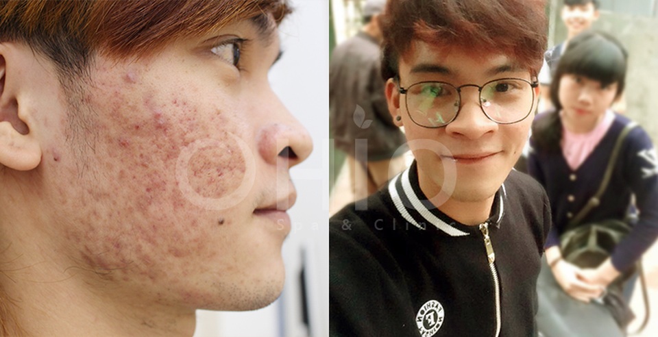Công nghệ laser acnes giải pháp trị mụn hoàn toàn mới - 4 Hình ảnh khách hàng sau điều trị mụn công nghệ Laser Acnes
