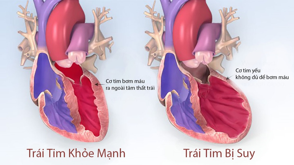Suy tim - chặng đường cuối nhọc nhằn của các bệnh tim mạch - 1 Suy tim là bệnh mạn tính, khó có thể chữa khỏi hoàn toàn và là biến chứng chung của tất cả các bệnh tim mạch.
