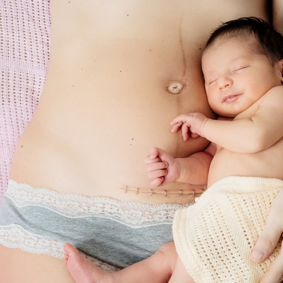 Sống cùng đam mê, xóa nỗi lo về sẹo - 1 Hình sẹo mổ