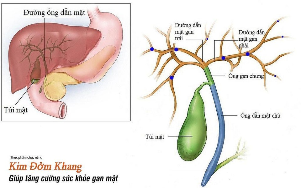 Bị sỏi mật trong gan, tránh chủ quan nếu không muốn phải mổ gan lấy sỏi - 2 Sỏi gan có thể gây ra nhiều biến chứng nguy hiểm