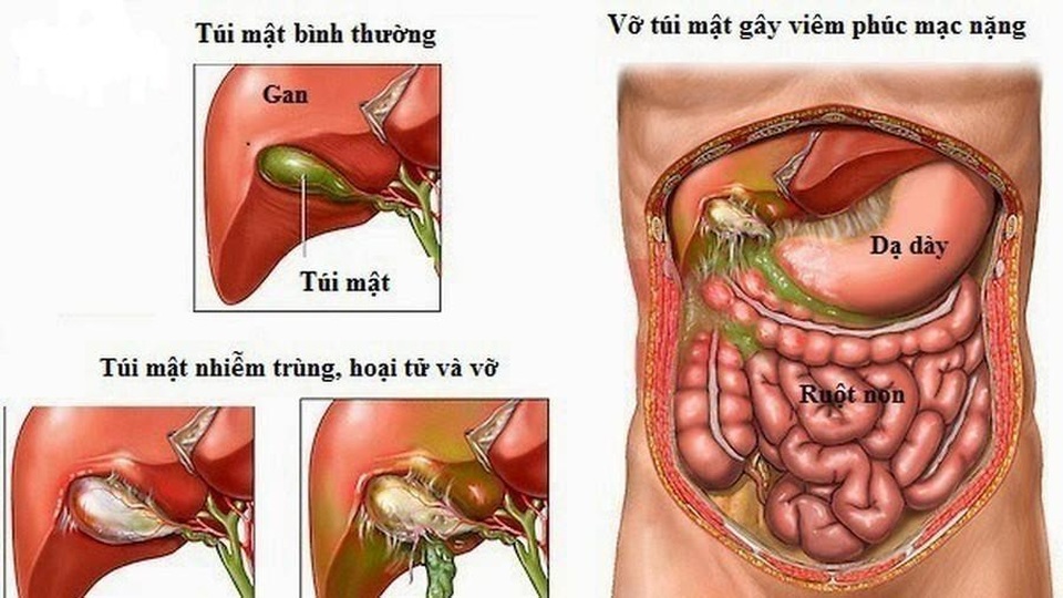 Viêm túi mật cấp hay mạn tính, chủ quan đều nguy hiểm - 1 Viêm túi mật có thể gây biến chứng hoại tử túi mật