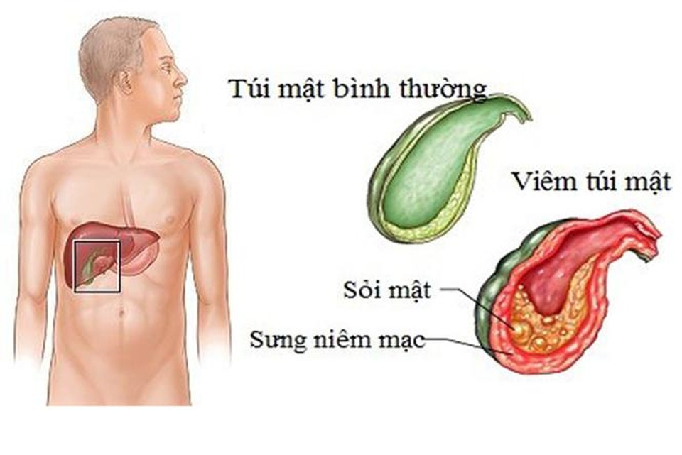 Biến chứng sỏi mật nguy hiểm - Coi nhẹ dễ tử vong! - 1 Sỏi mật là những lắng đọng bất thường ở trong dịch mật