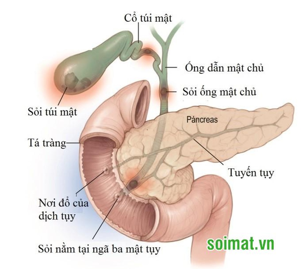 Biến chứng sỏi mật nguy hiểm - Coi nhẹ dễ tử vong! - 2 Tùy thuộc vị trí phát triển mà sỏi mật có thể gây ra nhiều biến chứng nguy hiểm