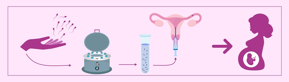 Thêm một giải pháp hỗ trợ sức khỏe sinh sản cho các cặp vợ chồng vô sinh hiếm muộn - Ảnh 2. Thêm một giải pháp hỗ trợ sức khỏe sinh sản cho các cặp vợ chồng vô sinh hiếm muộn - Ảnh 2.