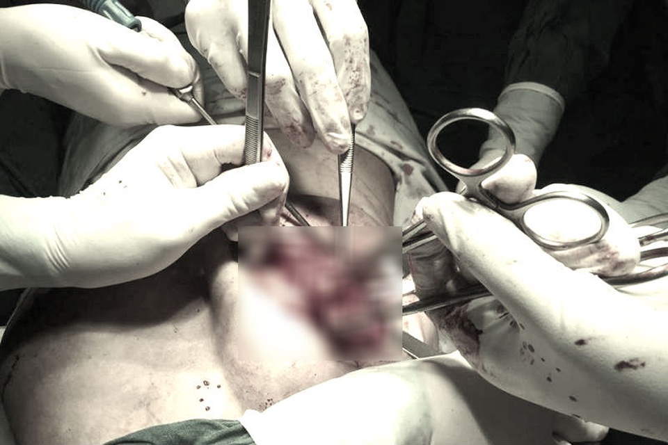 Ôm hận khi chi hàng trăm triệu “xuất ngoại” sửa mũi - 2 Các BS phẫu thuật lấy silicon lỏng ra khỏi ngực bệnh nhân