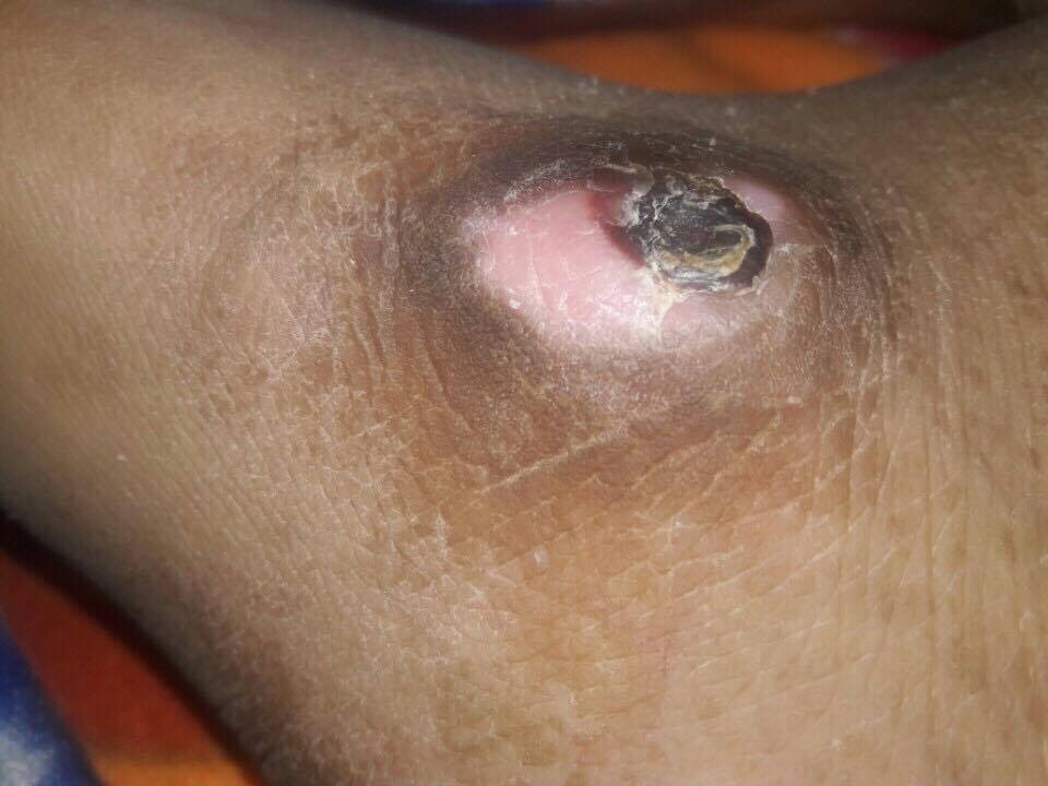 Thương xót chàng thanh niên bị tai nạn lao động nhiều lần phải bỏ viện về nhà - 3 Thương xót chàng thanh niên bị tai nạn lao động nhiều lần phải bỏ viện về nhà - 3