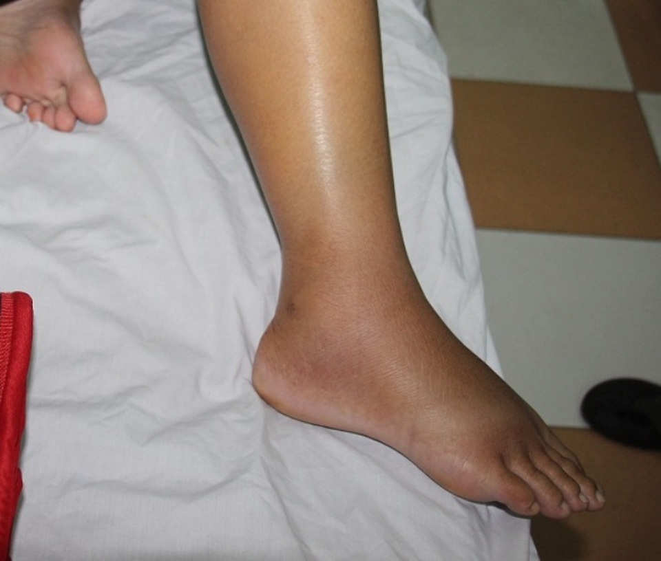 Dân bất an vì nhiều người bị rắn lục đuôi đỏ cắn sau lũ - 2 Chân chị Phụ bị sưng tấy vì bị rắn lục đuôi đỏ cắn