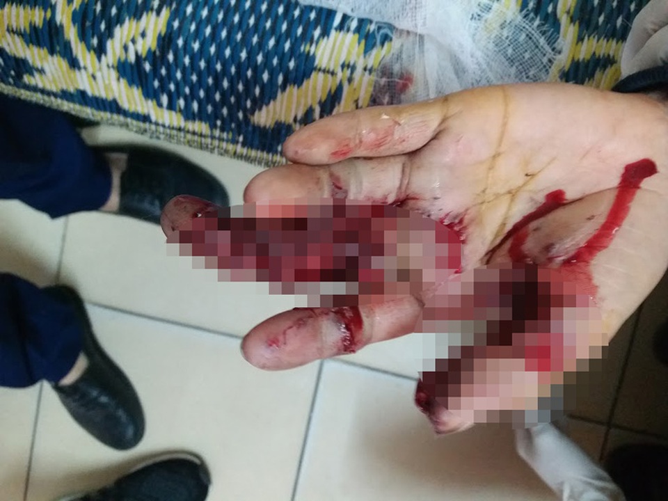 Một học sinh mất ngón tay vì tạo pháo bằng thuốc diêm - 1 Bàn tay trái của cháu T. bị dập nát và phải tháo hẳn ngón thứ 3