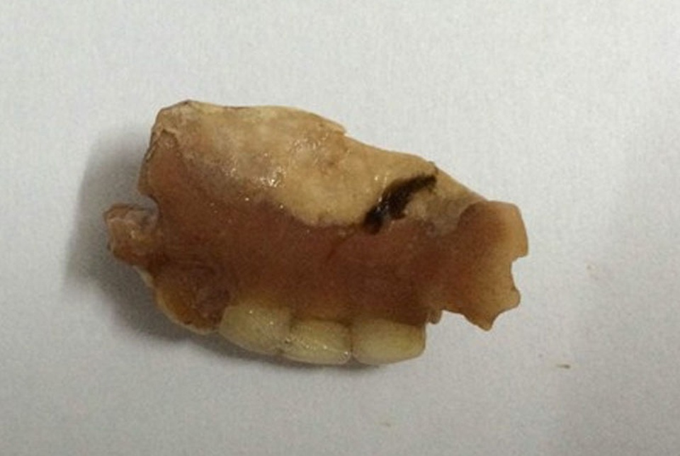 Tức ngực, khó thở vì răng giả chui vào dạ dày - 3 Hàm răng giả có kích thước 2cm x 3cm được lấy ra từ bụng bệnh nhân