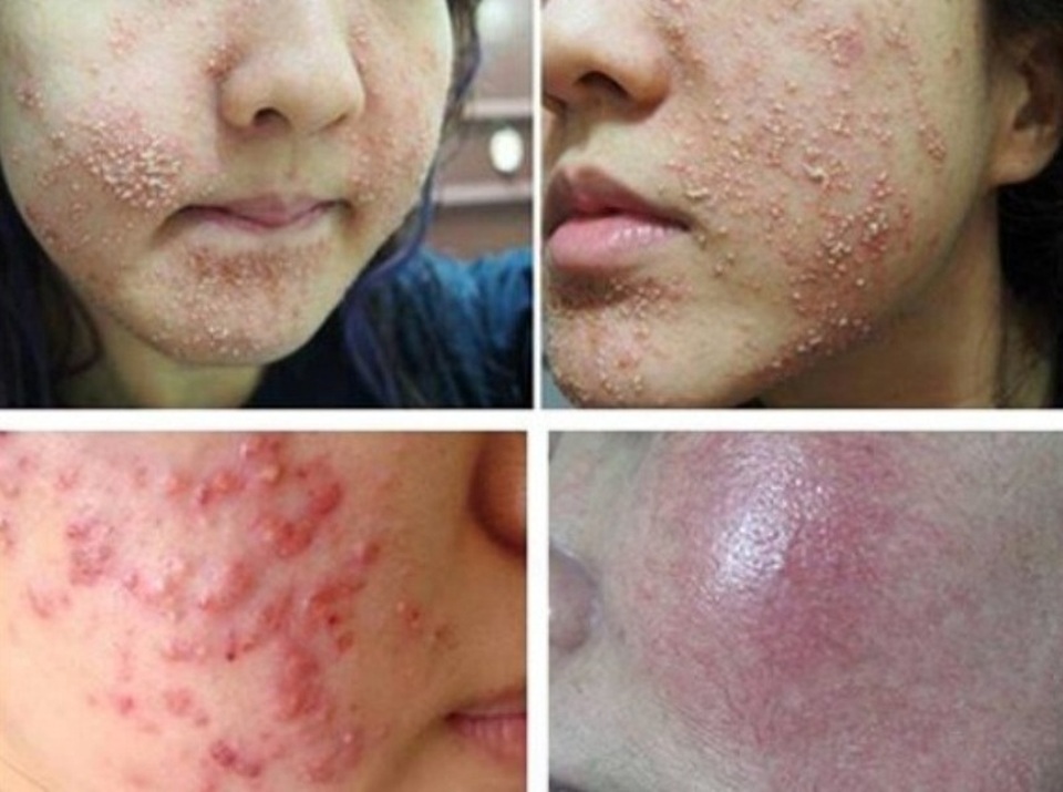 Kem trộn, kem tắm trắng: thần dược hay độc dược - 4
Da mặt dị ứng, viêm nhiễm do sử dụng kem không rõ nguồn gốc. Nguồn: Internet