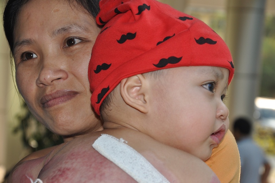 Cô bé Thảo My bị bỏng nặng, hỏng 1 mắt được xuất viện trở về nhà - 3 Cô bé Thảo My bị bỏng nặng, hỏng 1 mắt được xuất viện trở về nhà - 3