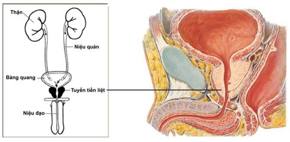 Hơn 1/2 nam giới trên 45 tuổi mắc u xơ tiền liệt tuyến - 2 Hơn 1/2 nam giới trên 45 tuổi mắc u xơ tiền liệt tuyến - 2