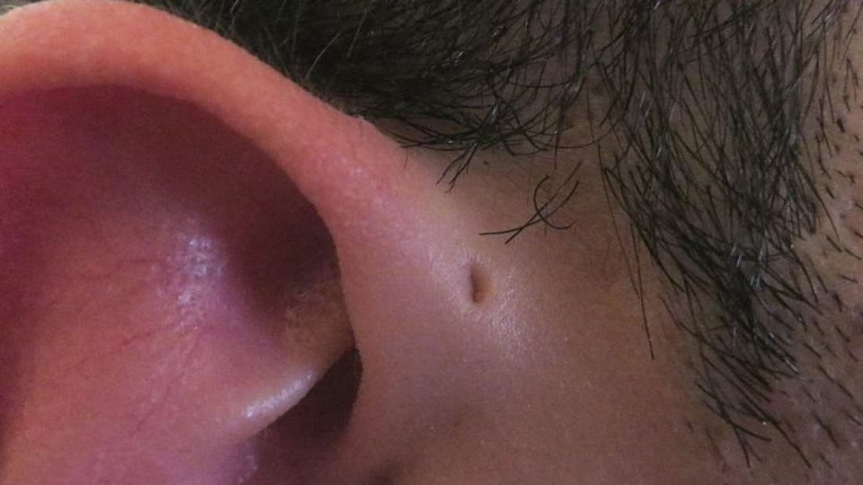 Tại sao nhiều người lại có một lỗ nhỏ xíu ở tai? - 1 Tại sao nhiều người lại có một lỗ nhỏ xíu ở tai? - 1
