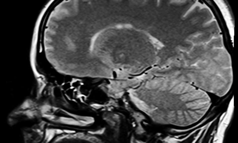 
Lần đầu tiên các nhà khoa học tại Đại học Manchester đã chỉ ra rằng, nếu não được “điều chỉnh trong” đến một tần số cụ thể thì cơn đau mãn tính có thể được giảm nhẹ.
