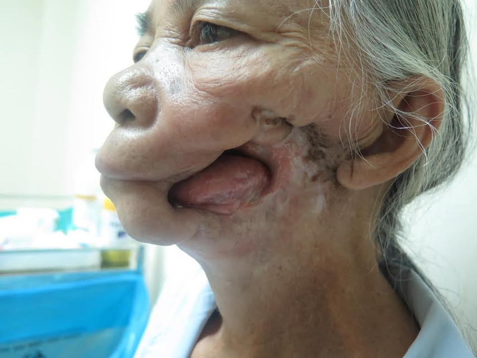 Phẫu thuật 9 giờ cứu cụ bà 73 tuổi mắc tổn thương phức tạp - 1