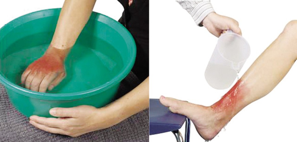 “Thời gian vàng” giúp nạn nhân bị bỏng hạn chế tai biến - 1 Việc sơ cứu ban đầu đúng cách khi bỏng rất quan trọng, có thể coi là “thời gian vàng” giúp nạn nhân hạn chế tai biến. Ảnh: Internet
