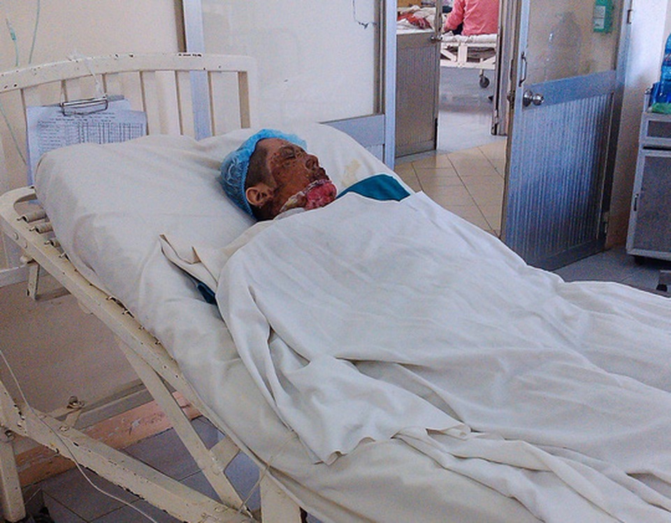 Một phụ nữ sống tại thị xã Dĩ An, tỉnh Bình Dương bị người tình dùng xăng đốt (Ảnh: Anh Vượng)