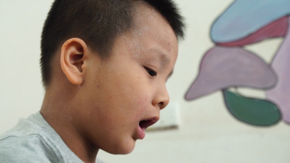 Hành trình điều trị viêm da cơ địa của cậu bé 6 tuổi - 1 Hành trình điều trị viêm da cơ địa của cậu bé 6 tuổi - 1