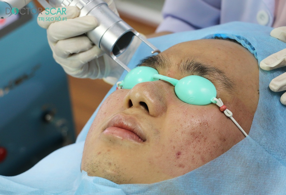 Chuyên gia tư vấn cách điều trị sẹo rỗ hiệu quả - 1 Chuyên gia tư vấn cách điều trị sẹo rỗ hiệu quả - 1
