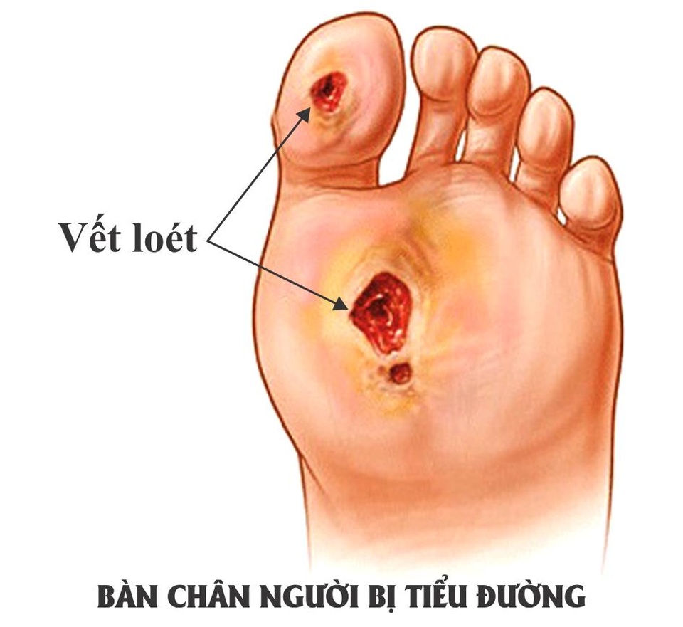 Cảnh báo dấu hiệu tê bì chân tay ở bệnh nhân tiểu đường - 1 Vết loét bàn chân ở người bị tiểu đường