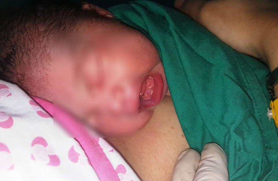 Bé gái Sài Gòn mọc 2 răng cửa khi vừa chào đời - 2 Bé gái vừa sinh đã mọc 2 răng cửa