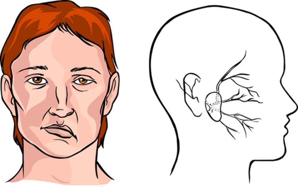 Trúng gió méo miệng nhưng nguy hiểm cho mắt - 2 Trúng gió méo miệng nhưng nguy hiểm cho mắt - 2