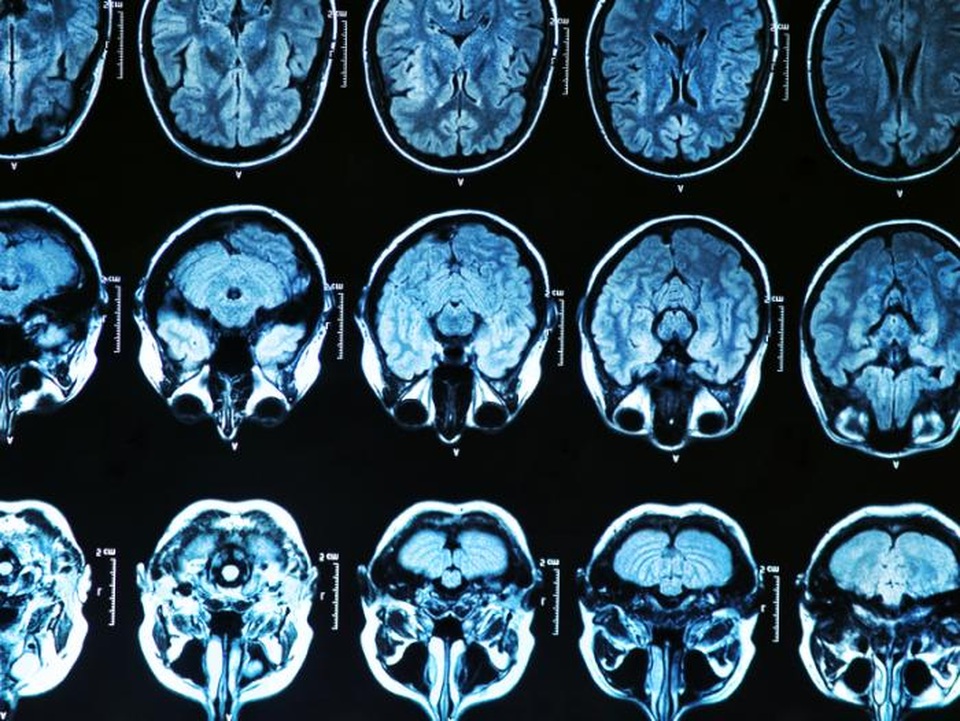 Loãng xương có thể liên quan đến bệnh Alzheimer - 1 Loãng xương có thể liên quan đến bệnh Alzheimer - 1