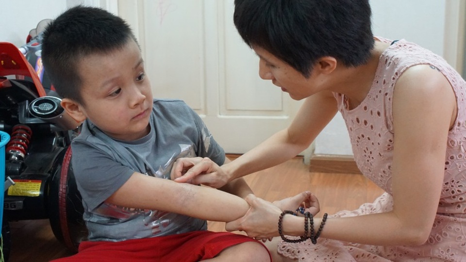 Hành trình điều trị viêm da cơ địa của cậu bé 6 tuổi - 2 Hành trình điều trị viêm da cơ địa của cậu bé 6 tuổi - 2