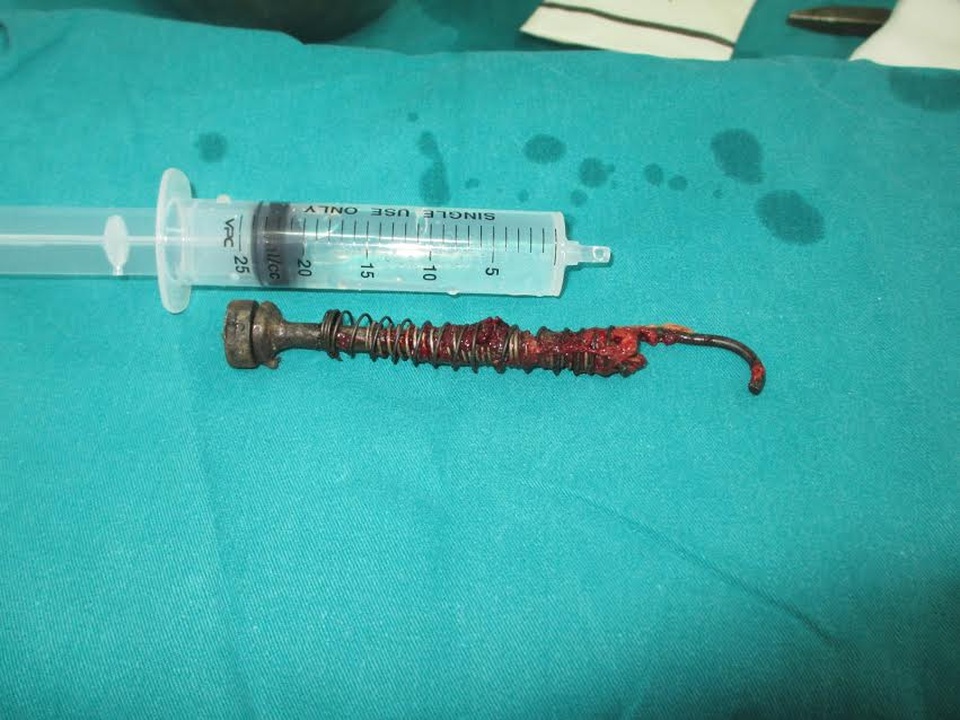 Xuyên đêm cấp cứu bệnh nhân bị đinh vít sắt đâm xuyên mặt - 2 Chiếc đinh vít gớm ghiếc dài hơn 10cm được lấy ra khỏi mặt bệnh nhân.