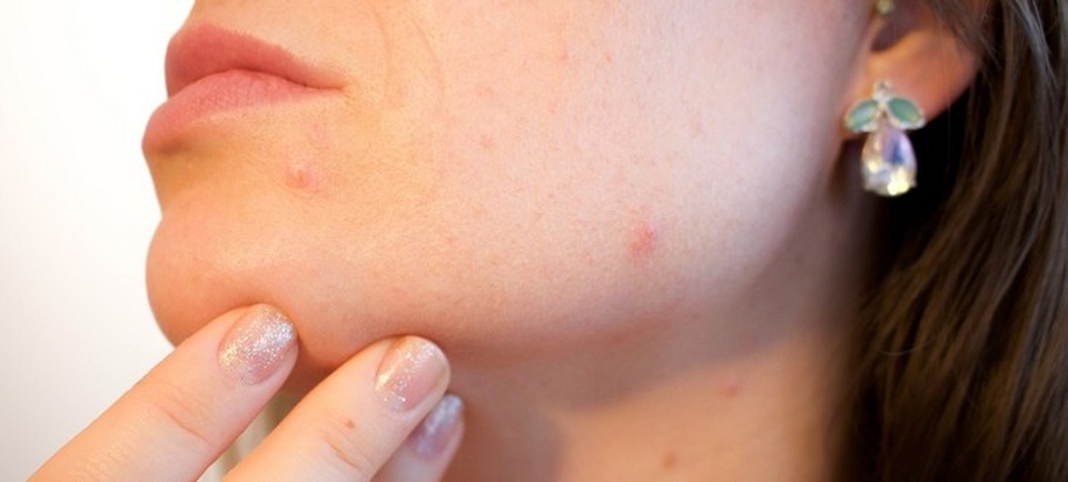 6 lợi ích của đá lạnh với da mặt phụ nữ - 2 6 lợi ích của đá lạnh với da mặt phụ nữ - 2