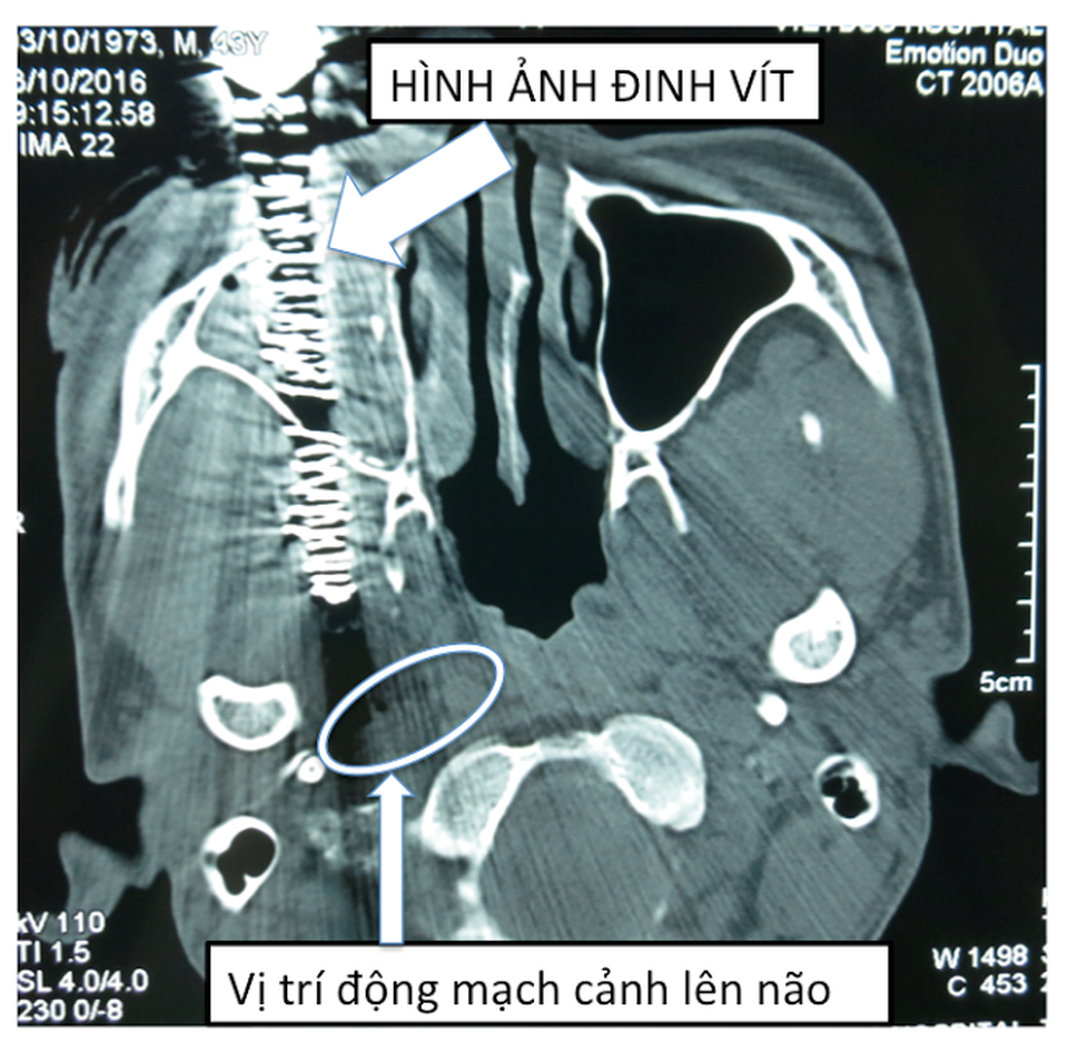 Xuyên đêm cấp cứu bệnh nhân bị đinh vít sắt đâm xuyên mặt - 3 Hình ảnh đinh vít còn cách động mạch cảnh 5mm trên phim chụp cắt lớp (rất may chưa tổn thương đến mạch cảnh).