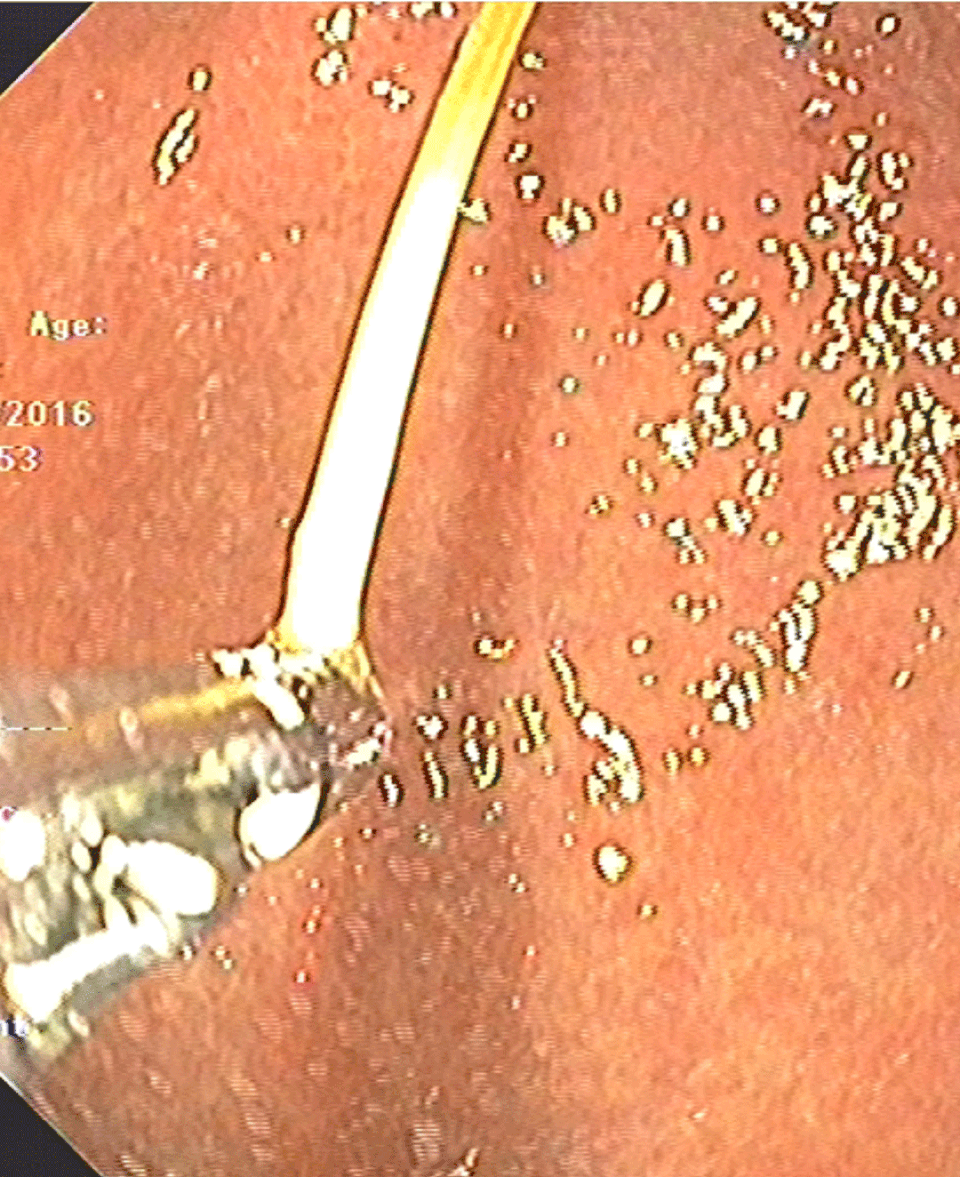 Chiếc tăm đâm thẳng vào hang vị