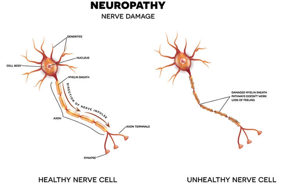 7 biến chứng thường gặp khi không điều trị tiểu đường "đến nơi đến chốn" - 4