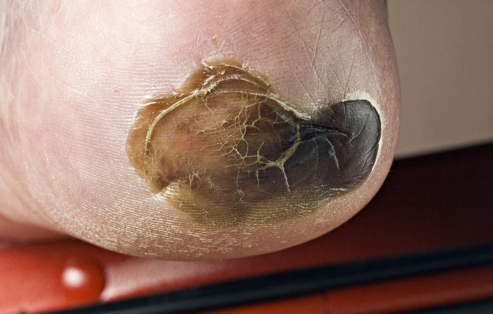 7 biến chứng thường gặp khi không điều trị tiểu đường "đến nơi đến chốn" - 5