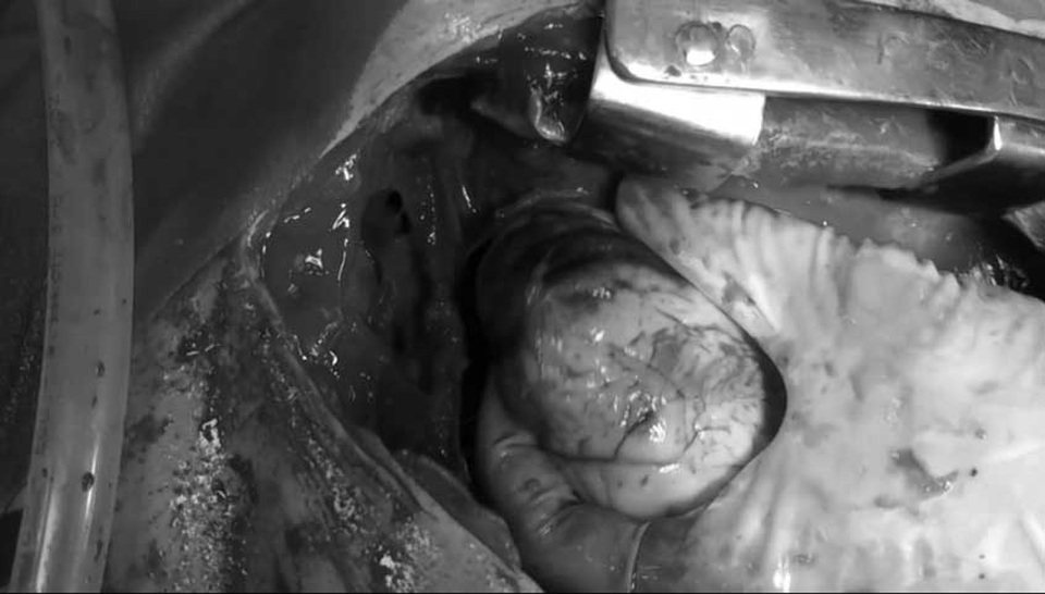 Hy hữu ca mổ cứu bệnh nhân sốc nặng do bị rút vật nhọn khỏi tim - 1
Quả tim bị thủng 2 lỗ