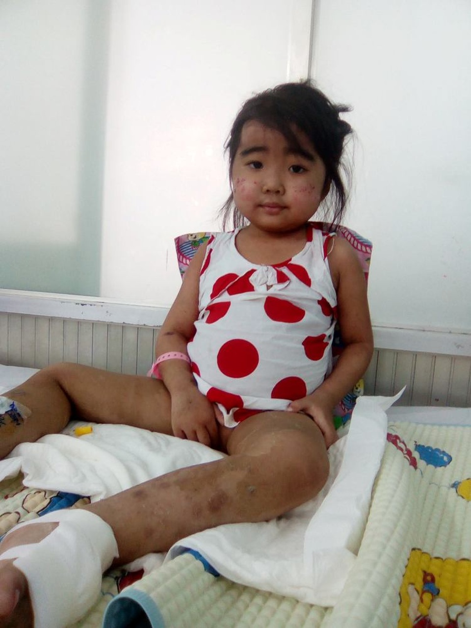 Thương bé 5 tuổi mang trên mình căn bệnh quái ác - 1 Bé Vàng Khuyên trong thời gian điều trị tại bệnh viện Nhi Đồng I