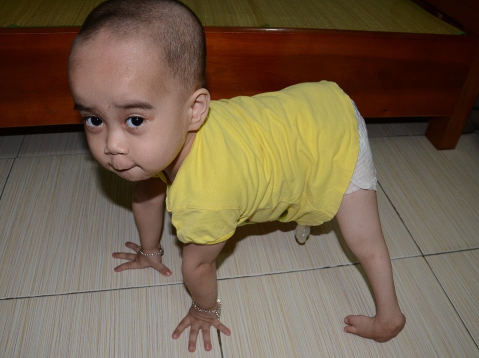 Thương 2 chị em mắc đa dị tật, suy giảm miễn dịch bẩm sinh - 1
Bé Thùy Dương (4 tuổi) bị mắc đa dị tât: Viêm thắt lưng cột sống, thiếu đốt xương sống cùng cụt, cứng đa khớp, teo cơ 2 chân, bàn chân trái vẹo, không có hậu môn