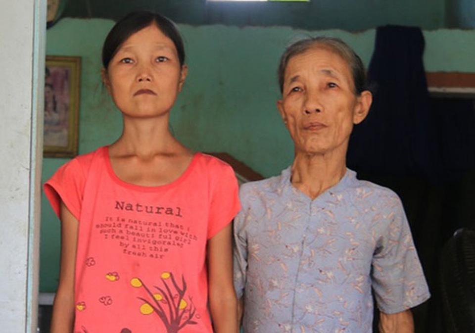 Cuộc đời bi kịch của những cô gái trẻ “hóa” bà lão ở Việt Nam - 4
Cô gái Nguyễn Thị Như Ý (trái) có khuôn mặt già nua, thân hình gầy gò vì căn bệnh hiếm gặp