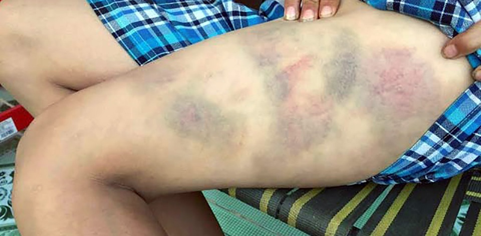 Cậu bé 13 tuổi bị bố đánh bầm dập vì mê chơi game - 2
Đùi cậu bé bầm tím sau 2 ngày bị bố đánh.