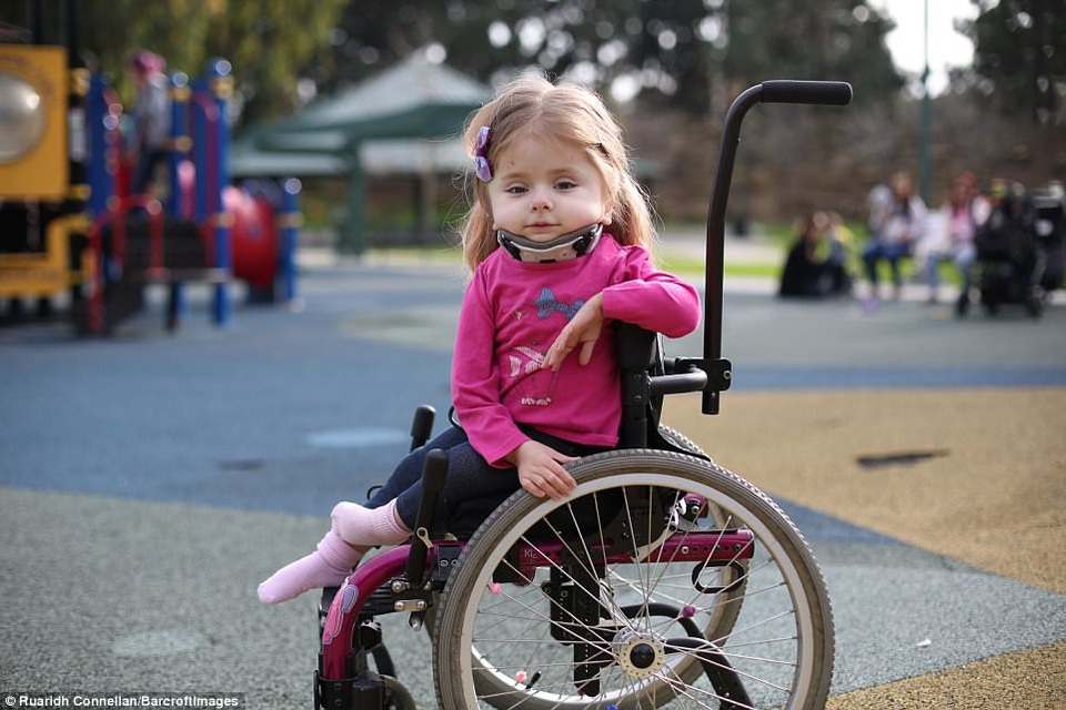 Cô bé Zoe Lush đến từ bang California, Mỹ, mắc phải hội chứng xương thủy tinh. Zoe đã bị gãy một số xương từ khi còn ở trong bụng mẹ, cô bé bị gãy xương đòn trong khi chào đời, và gãy khoảng 100 xương khác trong vòng một năm đầu đời.