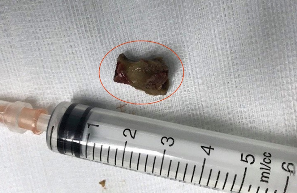 Ho dữ dội suốt 3 năm vì hóc xương gà - 2 Mẩu xương gà nằm trong cổ họng anh Thông suốt 3 năm được bác sỹ BVHNĐK Nghệ An gắp lấy thành công.