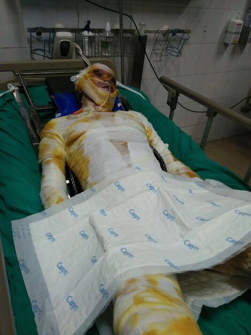 Gần 82 triệu đồng đến với gia đình 3 người bị bỏng - 2 Bác sĩ Thảo cho biết “Vết thương của bệnh nhân còn khoảng 30% nữa. Toàn trạng ổn định, các cơ quan hô hấp, tuần hoàn, thận bình thường.