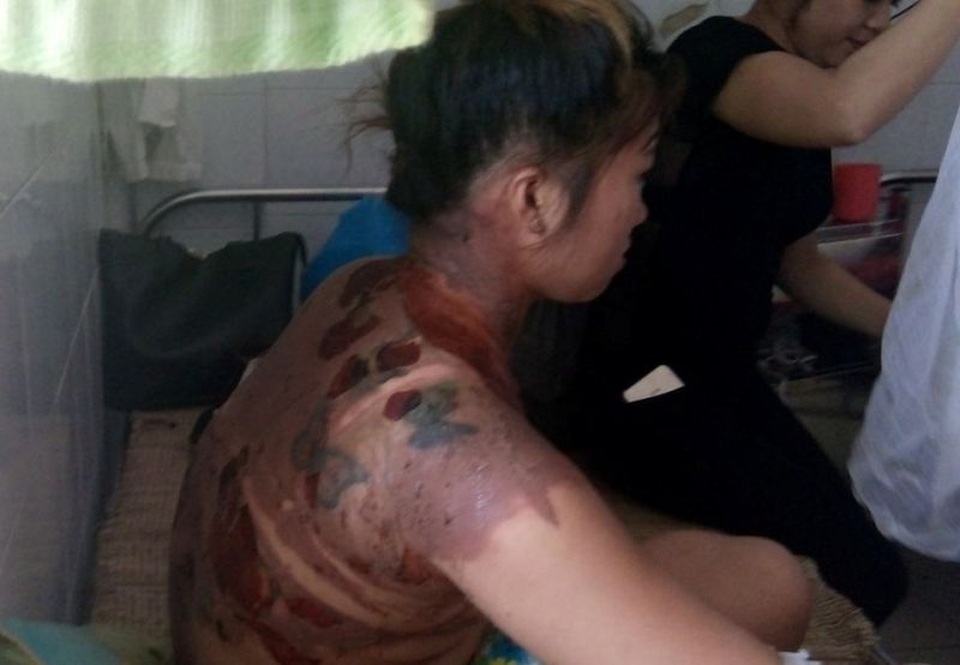 Chị Vui bị bỏng nhiều chỗ trên cơ thể