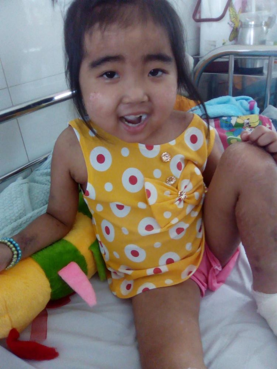 Thương bé 5 tuổi mang trên mình căn bệnh quái ác - 2 Bé Vàng Khuyên lúc điều trị tại bệnh viện Nhi Đồng I (TPHCM)