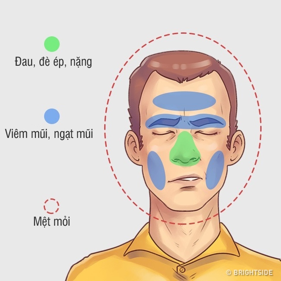 Ứng phó hiệu quả 5 kiểu đau đầu hay gặp - 2 Ứng phó hiệu quả 5 kiểu đau đầu hay gặp - 2