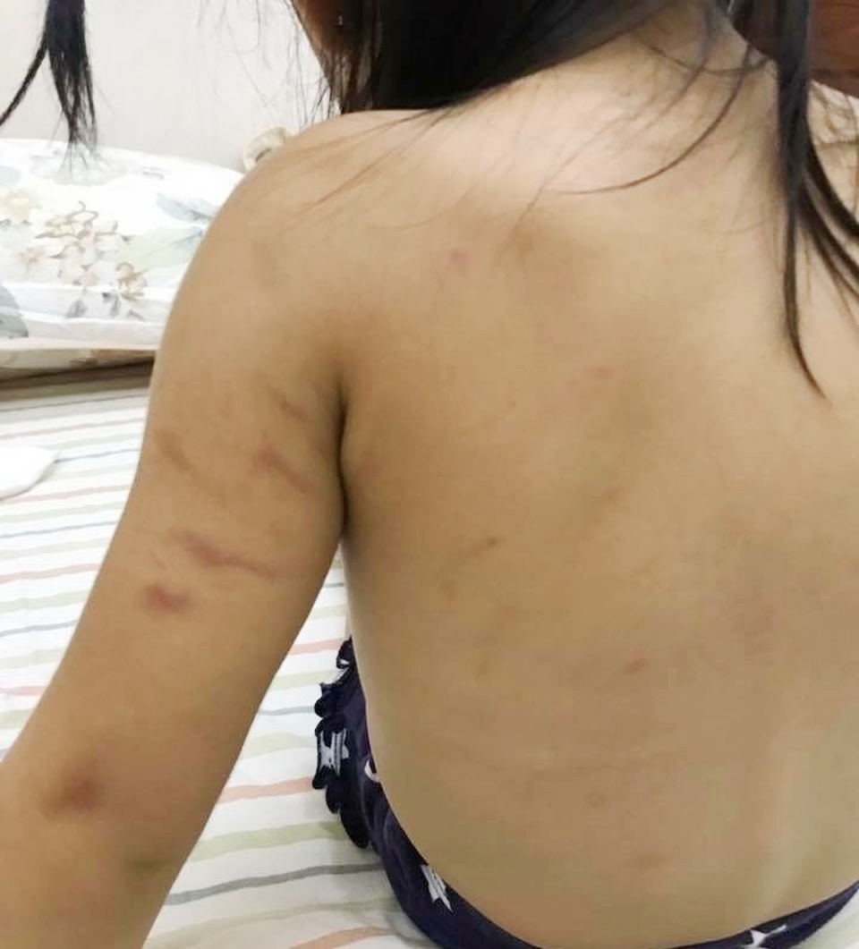 Bé gái 2 tuổi xuất hiện những vết bầm tím trên người lúc ở trường mầm non - 1 Những vết bầm tím trên tay và lưng cháu M.T.